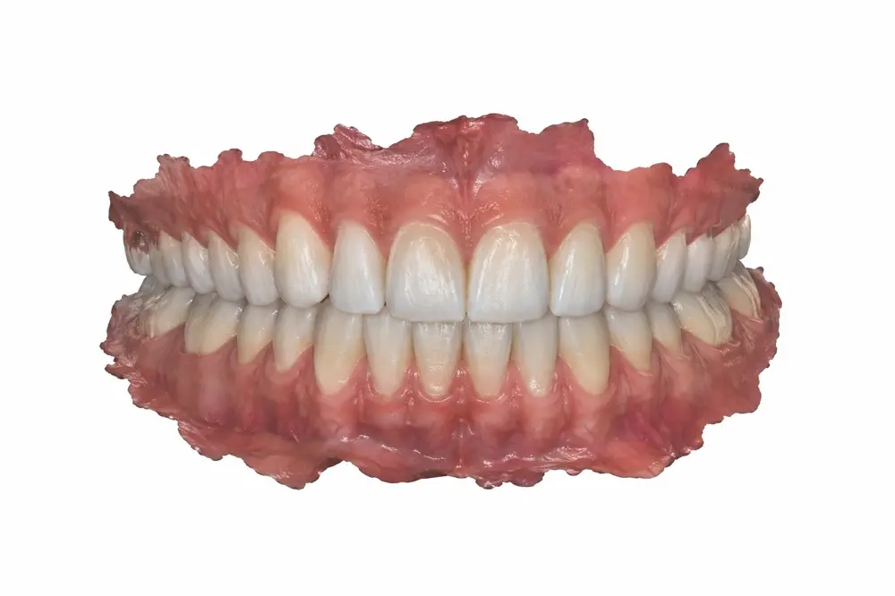 Hình quét 3D hàm răng bằng máy quét trong miệng