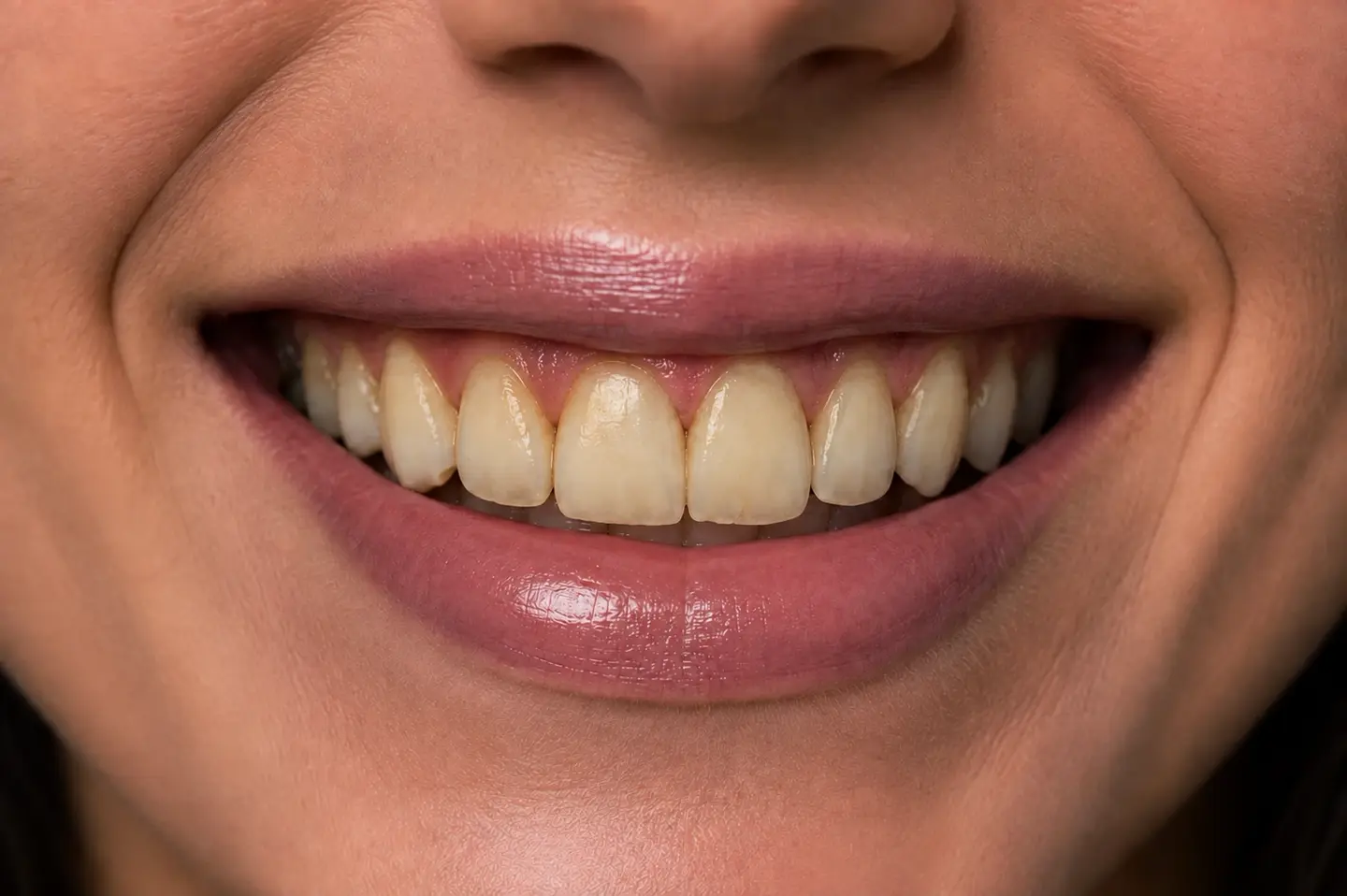 Ảnh minh hoạ nụ cười trước điều trị, răng ố vàng