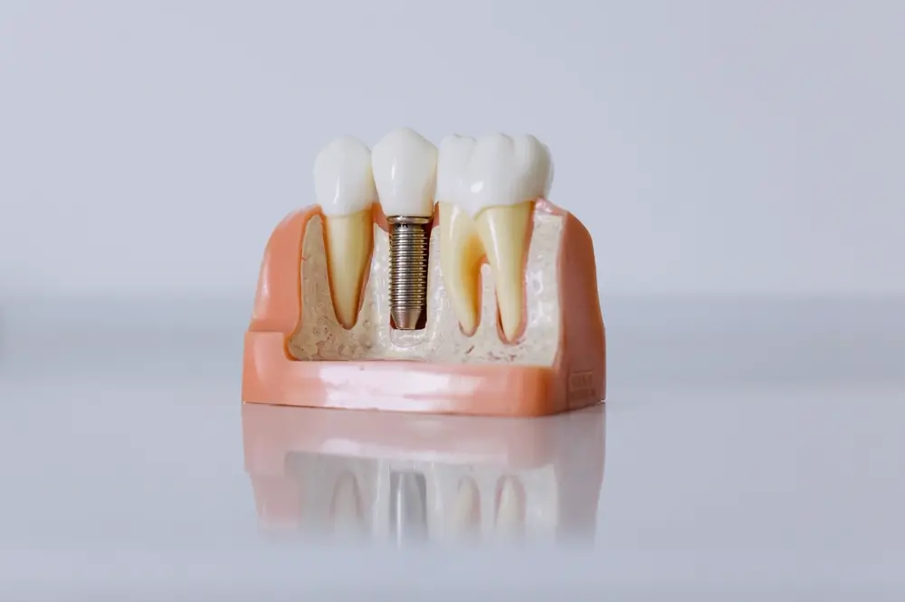 Mô hình trụ Implant cắm trong xương hàm